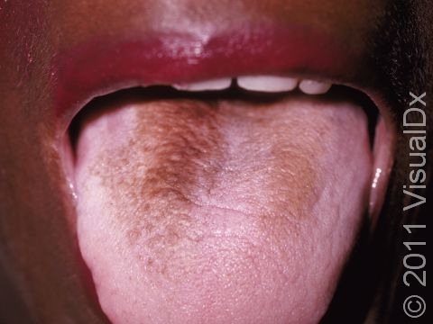 Hairy tongue involves small protuberances on the tongue that become thick and appear black.