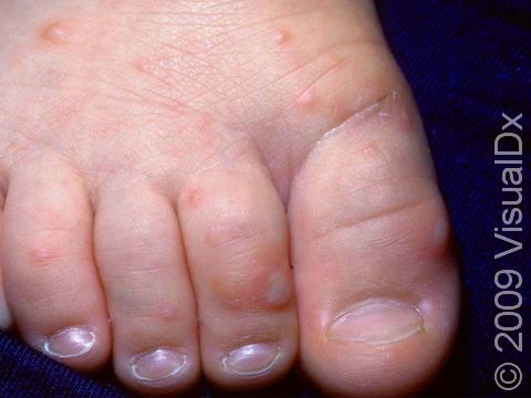 This image shows blisters on the top of the foot and toes typical of hand, foot, and mouth disease.
