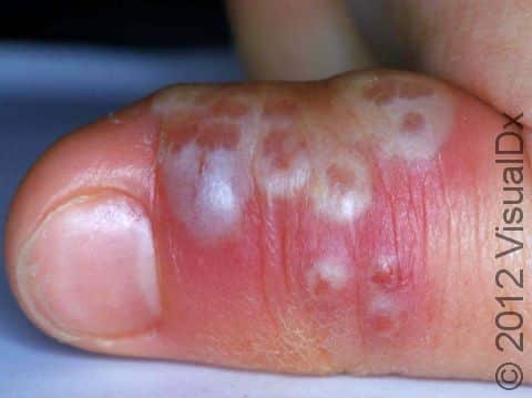 When the herpes virus infects a finger, it is known as a herpetic whitlow.