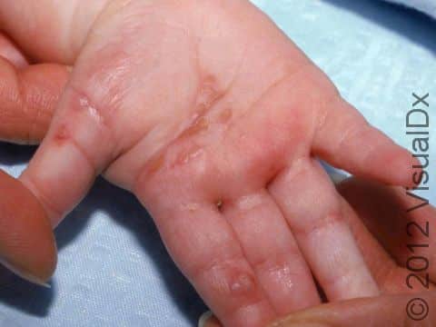 This image displays grouped blisters on the palm and fingers typical of a herpes virus infection.