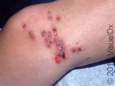 With a herpes virus skin infection, such as this one involving the leg, some blisters (vesicles) can have pus.