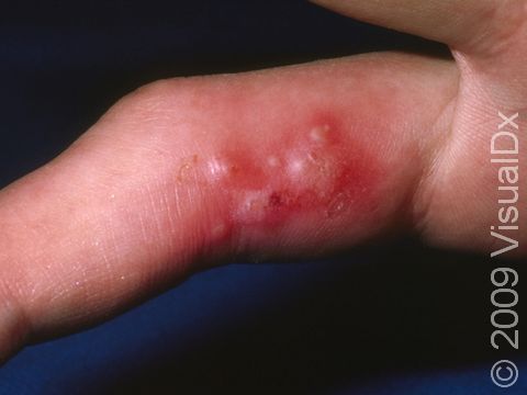 Herpetic Whitlow Condition Treatments And Pictures For Adults Skinsight
