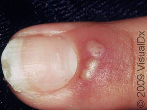 The blisters of a herpetic infection are usually grouped together, as displayed in this image.