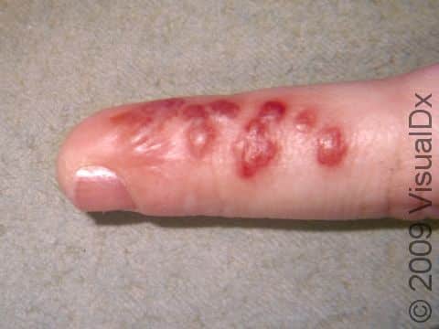 The blisters of a herpetic whitlow infection can be blood tinged.