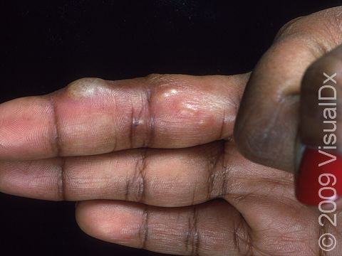 Blisters are common in the first occurrence of the herpes simplex virus.