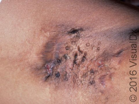 In hidradenitis suppurativa, there can be scarring and color changes seen from prior skin inflammation.