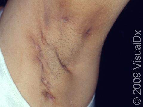 The armpit is a typical site of involvement. Notice the scars and pits in the skin.