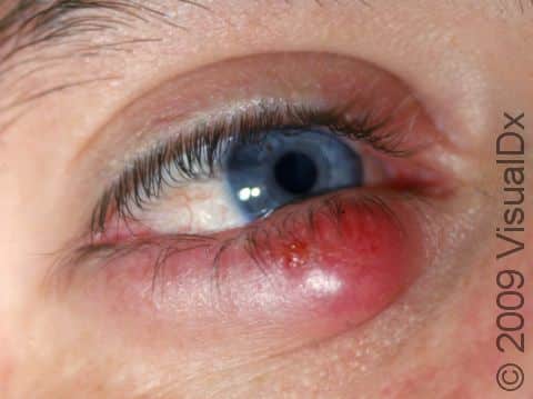 This large chalazion is most likely painful and must be treated vigorously to avoid developing bacterial complications.