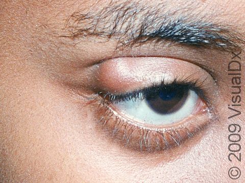 A chalazion/stye can occur on the outer angle of the eyelid.