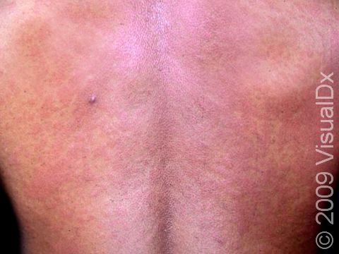 hiv lesions back