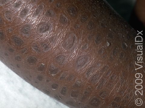 Ichthyosis vulgaris (