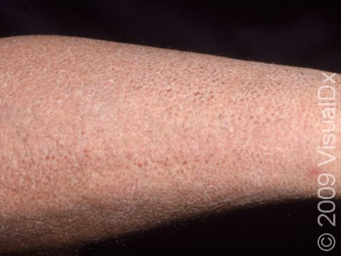 This image displays the appearance typical of ichthyosis vulgaris from retained scales.