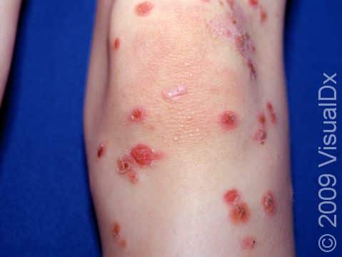 Impetigo can cause many scattered, red, and crusted skin lesions, as seen here.