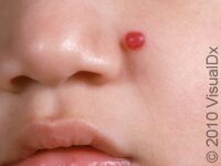 Strawberry Hemangioma (Infantile Hemangioma)