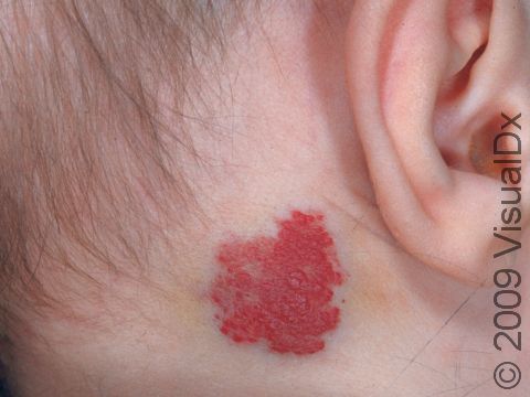 The face, neck, and scalp are typical locations for hemangiomas.