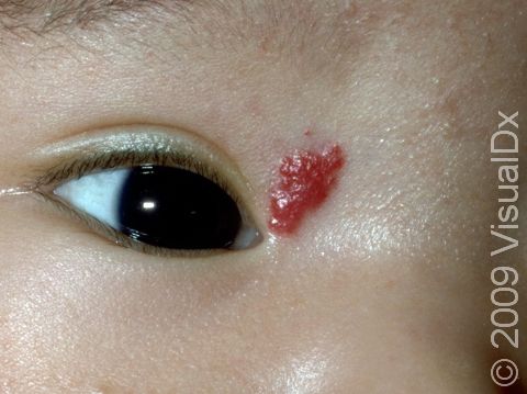 Strawberry red hemangiomas grow rapidly, and particularly those near the eye should be followed carefully by a dermatologist.