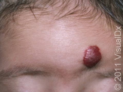 Hemangiomas often begin as a faint-red flat lesion and quickly enlarge to a deep-red raised bump. 