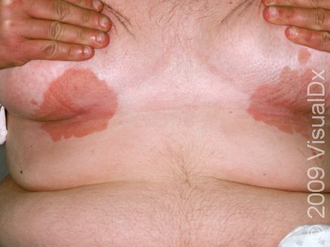 Red or brown, slightly elevated lesions with clear borders are typical of intertrigo.