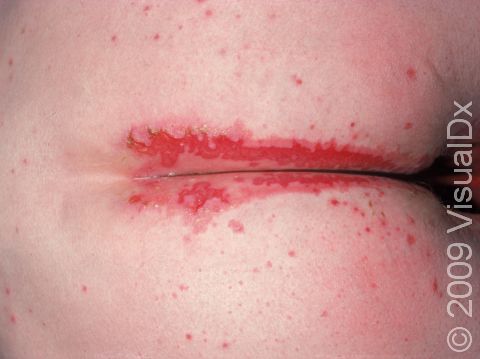 Skin erosions and superficial ulcers due to intertrigo, a skin irritation and inflammation in skin folds, are displayed.