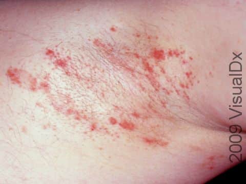 Intertrigo (irritation of body fold areas) may be displayed as irregular red patches and bumps.