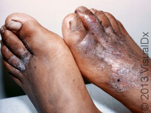 This image displays scale and redness typical of dermatitis (inflammation of the skin).
