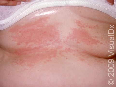 Irritant contact dermatitis from friction.