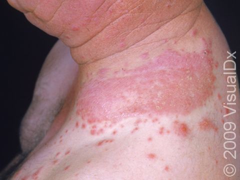 This image displays a severe case of irritant dermatitis.