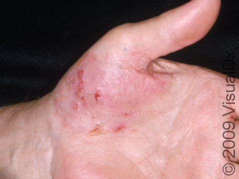 This image displays irritant dermatitis on the hand.