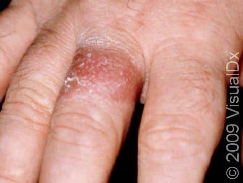 This image displays irritant dermatitis caused by a chemical trapped below the patient's ring.