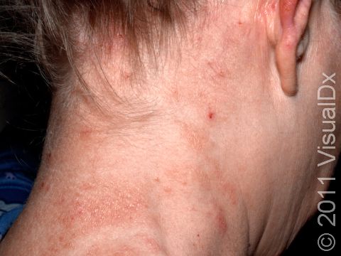 Reactions to perming solutions often affect the neck and backs of the ears more than the skin of the scalp, as seen in this image. 