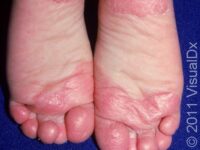 Sweaty Sock Syndrome (Juvenile Plantar Dermatosis) – Child