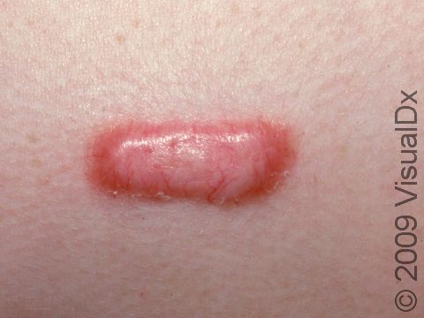 Keloids can appear bright red and inflamed.