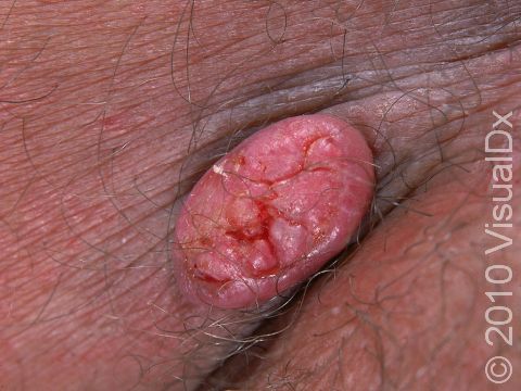 This image displays a larger keratoacanthoma occurring in a skin fold.