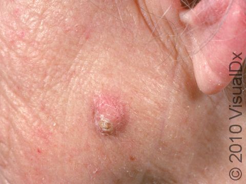 A keratoacanthoma appears on sun-damaged skin and typically has a red, firm base and central crust-like plug.