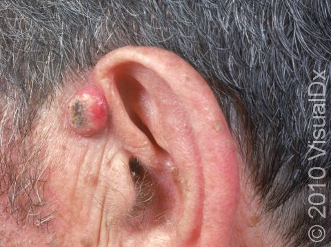 This image displays a typical keratoacanthoma in front of the top of the ear.
