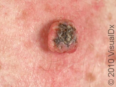 This image displays a lesion with a thick, scaly crust typical of keratoacanthoma.