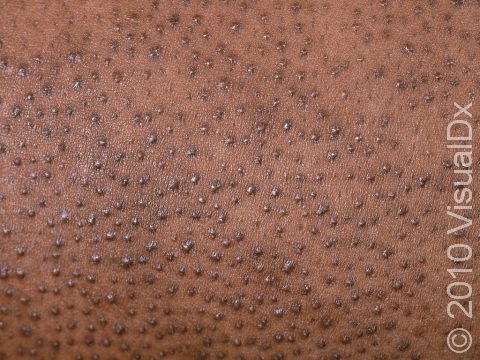 This image displays scaling and tiny bumps at the hair follicle typical of keratosis pilaris.
