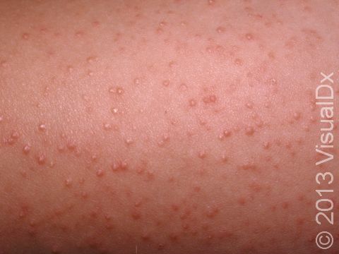 This image displays tiny, scaly elevations of the skin around the hair follicle typical of keratosis pilaris.