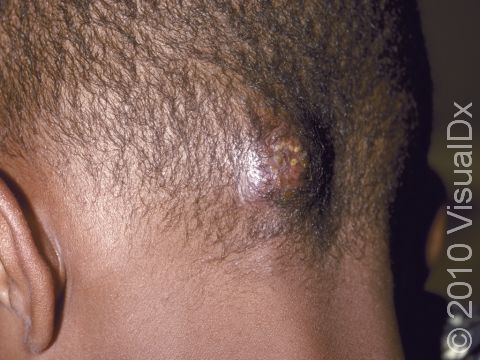 This image displays a kerion with a large lesion with pus-filled bumps present.