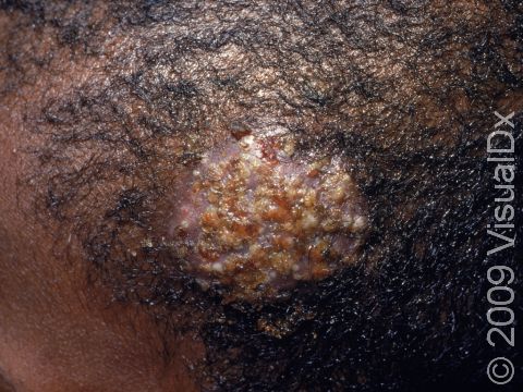 This image displays a kerion, a pus-filled reaction to fungus.