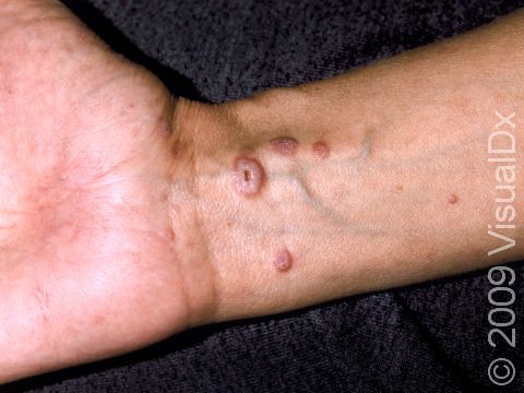 In lichen planus, flat-topped, slightly elevated lesions with scaling are frequently located on the wrist.
