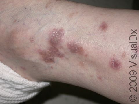 Lichen planus (seen near the ankle area here) often has a purple-brown discoloration, sometimes with scale.