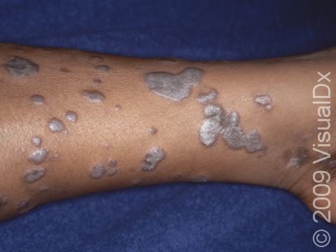 Lichen planus lesions may be numerous. The typical purple-brown discoloration and dull appearance due to scaling are apparent here.