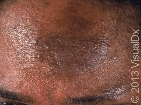 As displayed in this image, chronic rubbing and scratching can lead to darkening of the skin as well as skin thickening.