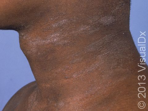 This image displays thickening of the skin with pronounced skin lines and some scaling on the neck typical of lichen simplex chronicus.