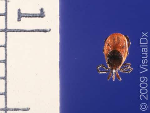 The tick of Lyme disease is very small. This ruler is in millimeters, showing a tick that is 3 mm in length.