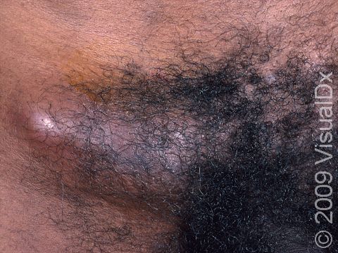 This image displays very large lymph nodes in the groin, typical of the sexually transmitted disease lymphogranuloma venereum.