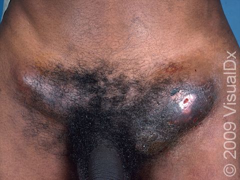 This image displays very large lymph nodes in the groin, typical of the sexually transmitted disease lymphogranuloma venereum.