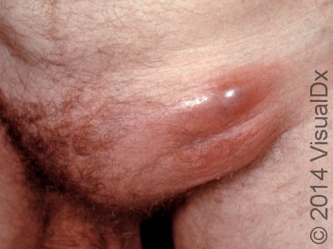 The second stage of lymphogranuloma venereum begins two to six weeks after the primary genital lesion and consists of painful swelling of the groin or other lymph nodes.
