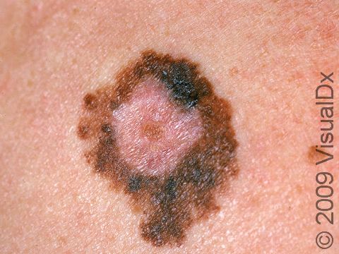 This image displays a multi-colored (including black) lesion with an irregular shape and scalloped borders typical of melanoma.